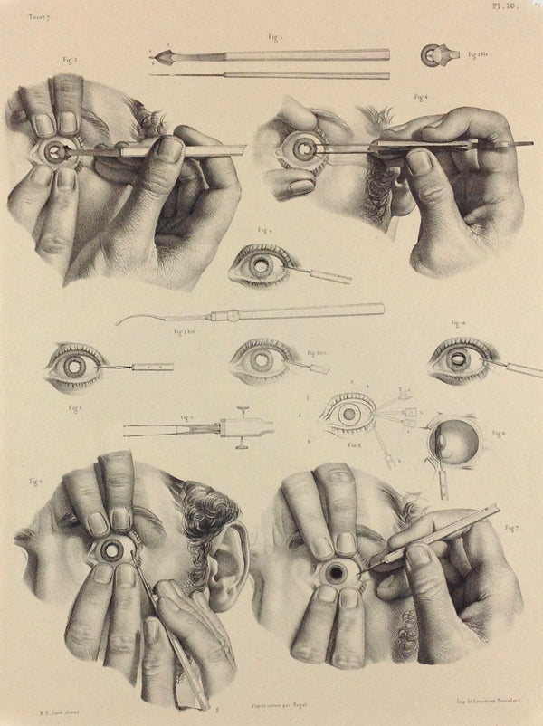 J.M. Bourgery, N.H. Jacob L'Anatomie de L'Homme, Opération de la Cataracte