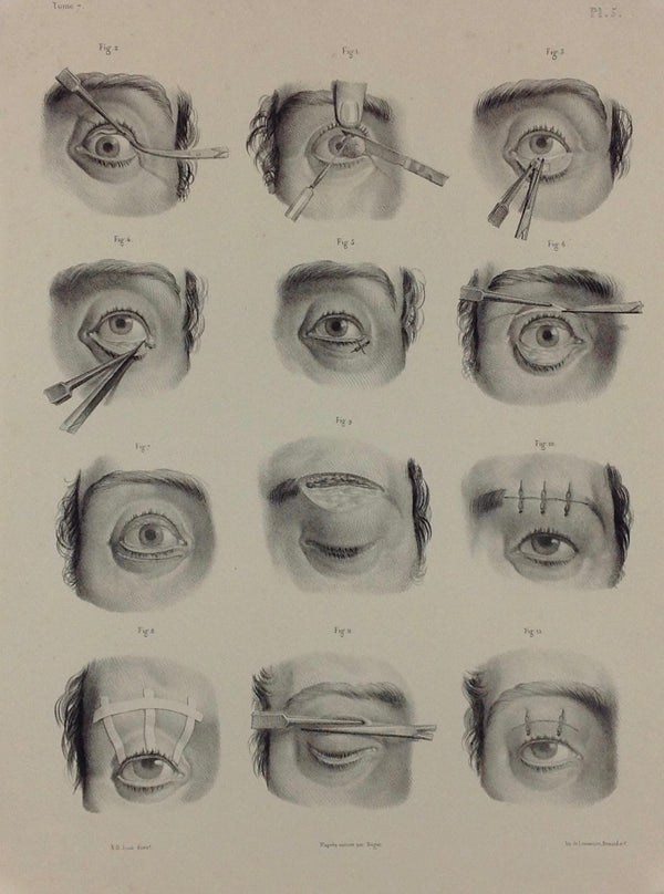 J.M. Bourgery, N.H. Jacob   L'Anatomie de L'Homme, Opérations curatives de la blépharoptose et de l'ectropion