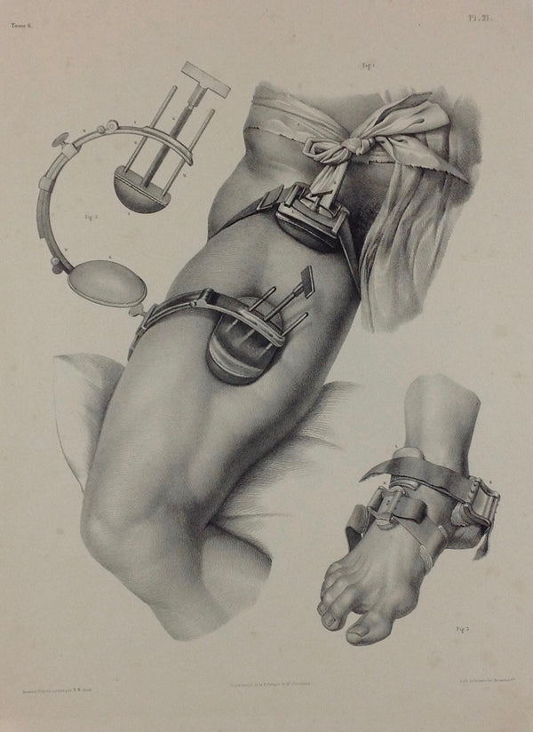 L'Anatomie de L'Homme, Compression des artères du membre abdominal