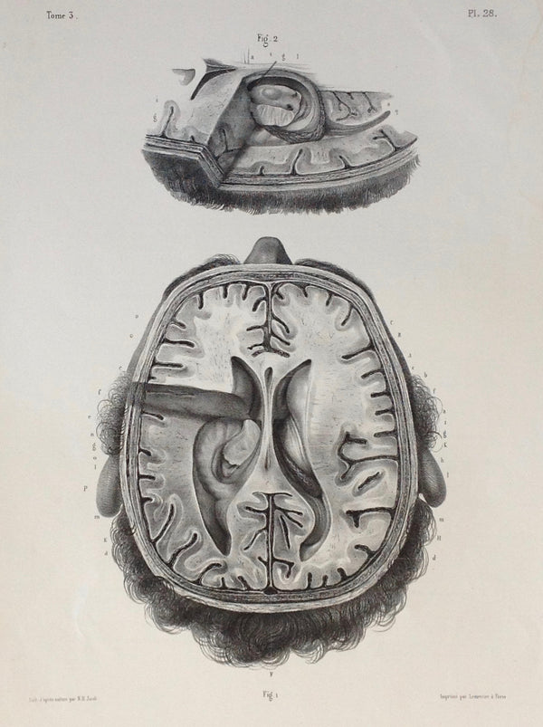 L'Anatomie de L'Homme, Ensemble des Ventricules latéraux